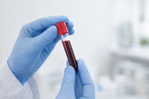 psa-blood-test
